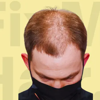 Before Hair Treatment Results