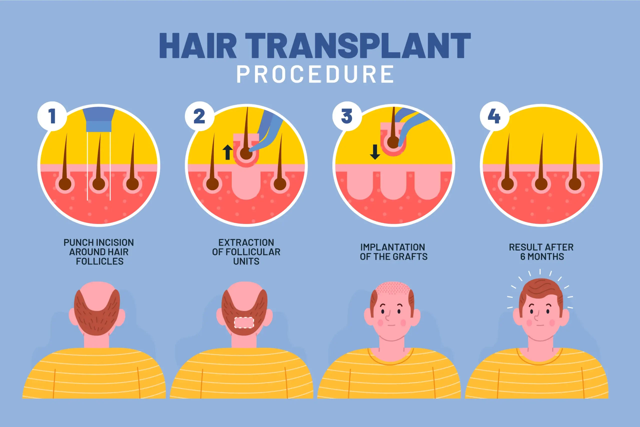 hair transplant clinic UK