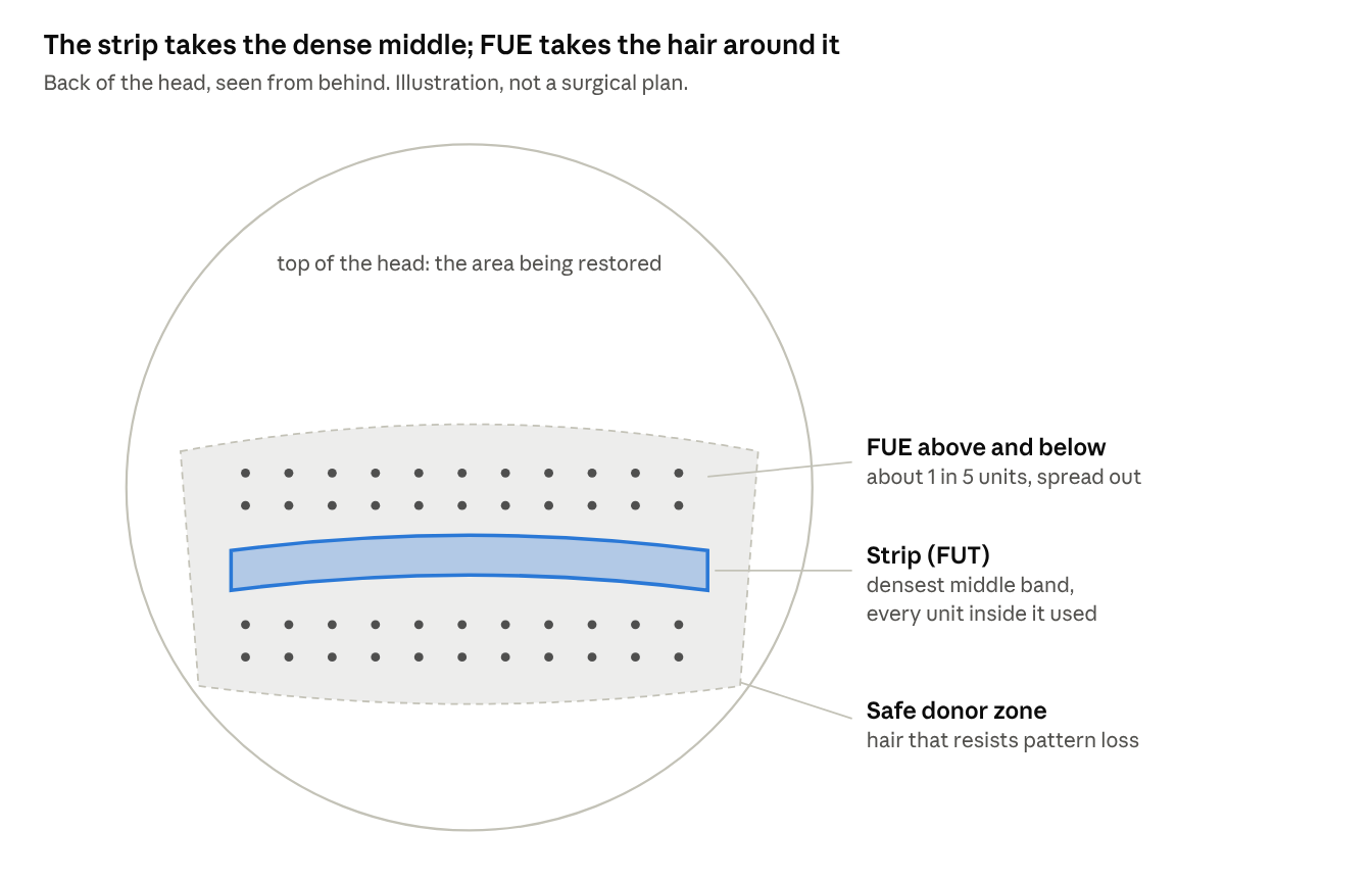 The strip takes the dense middle; FUE takes the hair around it