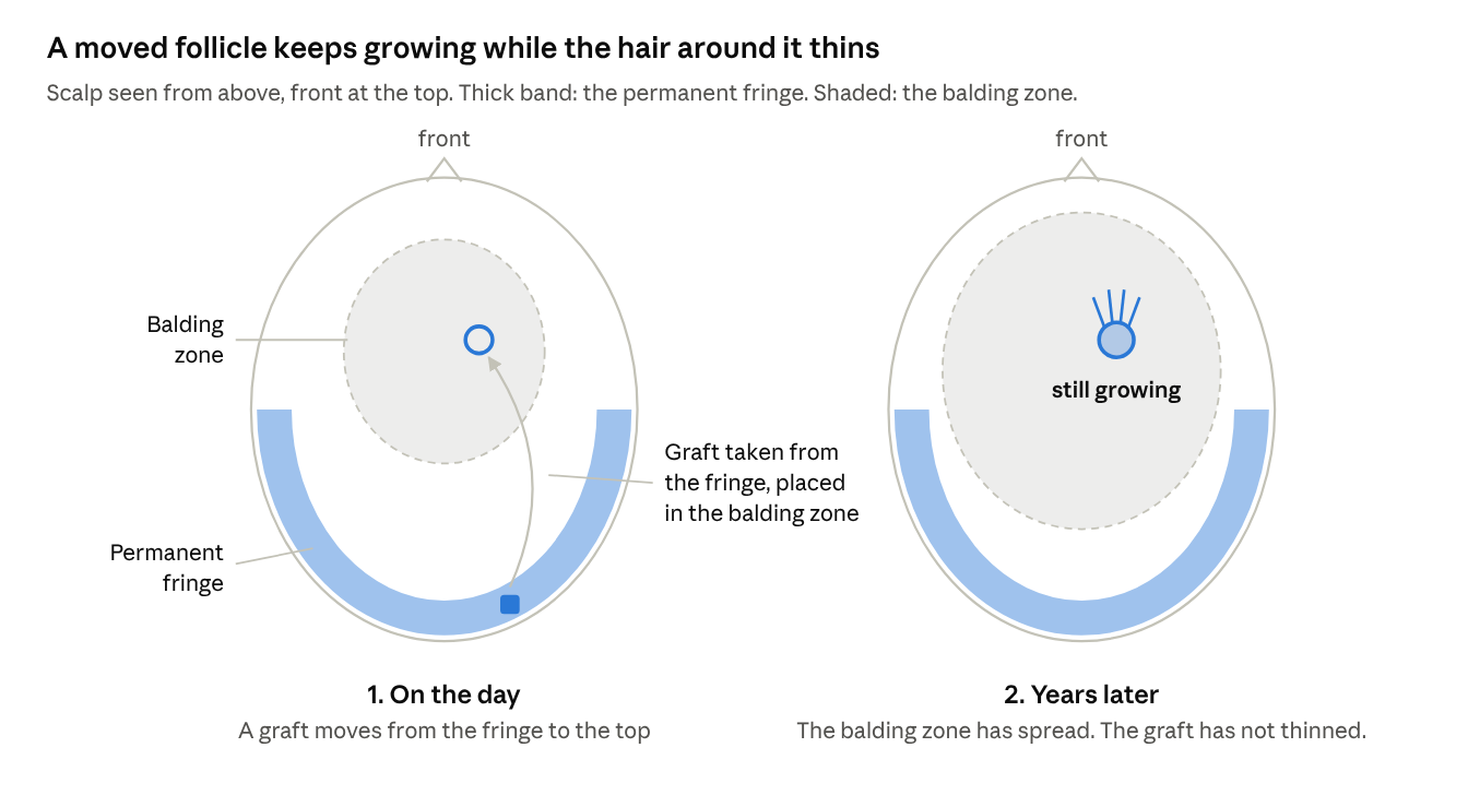 A moved follicle keeps growing while the hair around it thins