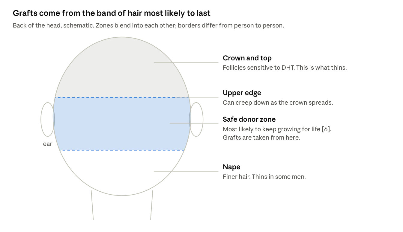 Grafts come from the band of hair most likely to last