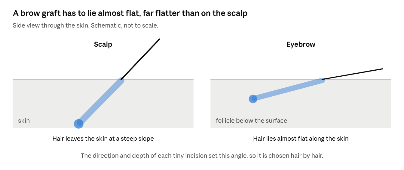 A brow graft has to lie almost flat, far flatter than on the scalp