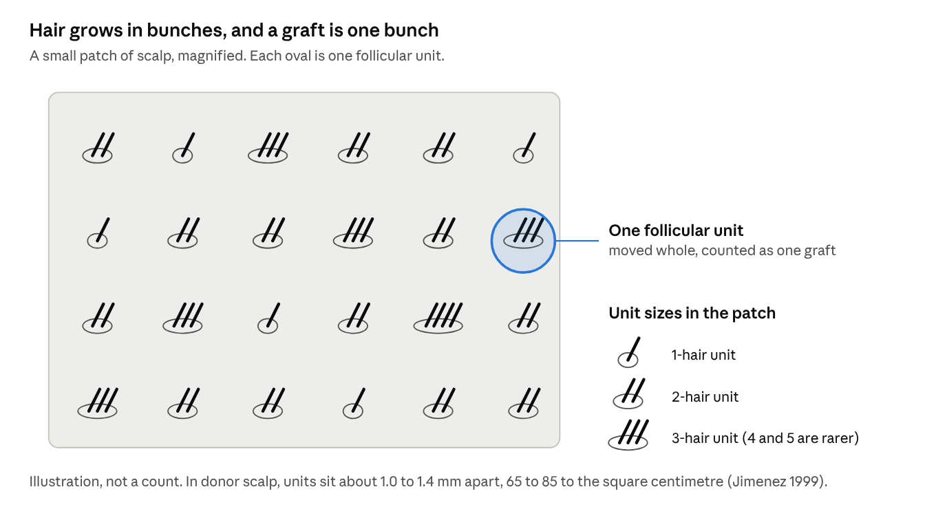Hair grows in bunches, and a graft is one bunch