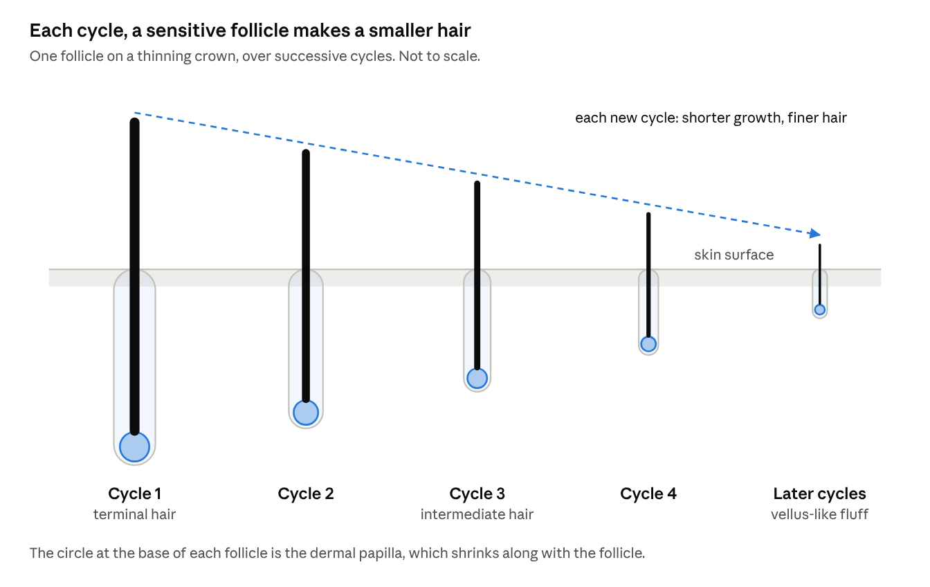 Each cycle, a sensitive follicle makes a smaller hair